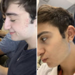 Squalene - before and after photos