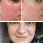 Squalene - before and after photos