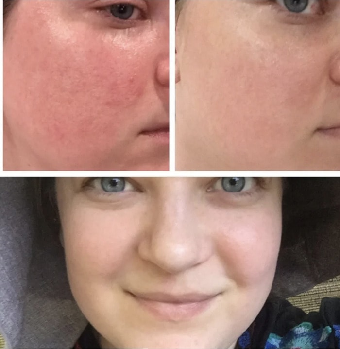 Squalane - before and after photos