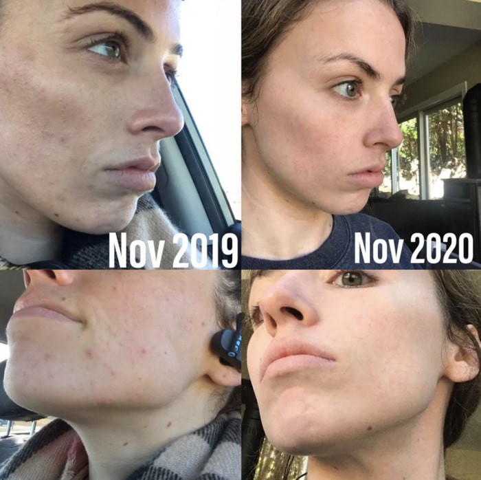 Squalane - before and after photos